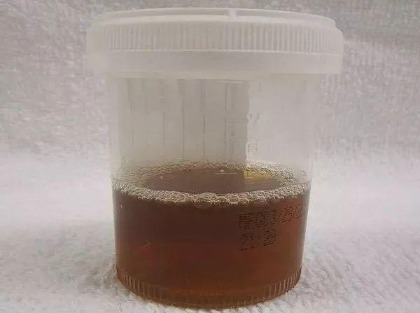 横纹肌溶解综合征:健身风险与科学预防