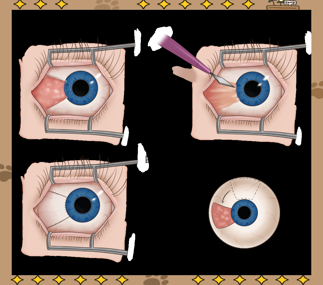 翼状胬肉:一种常见的眼表疾病及其防治方法