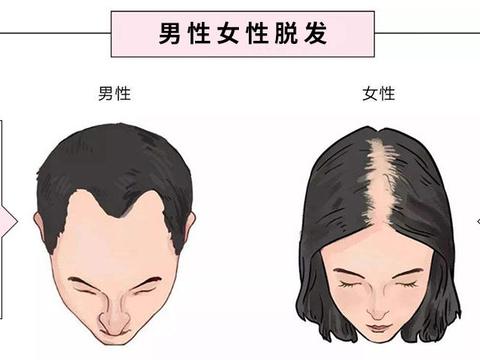 女性秃头|头发变薄要注意!重点分析脱发成因,预防治疗方法