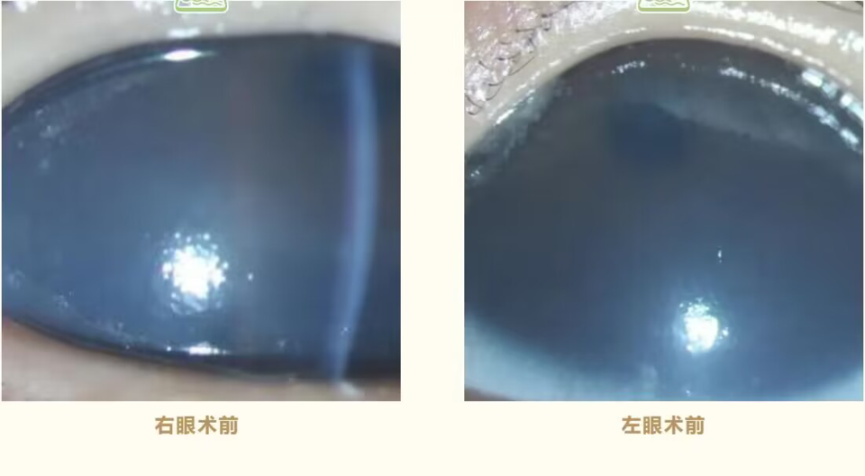 两个月大男婴患有先天性青光眼,青岛眼科医院精湛手术挽救视力