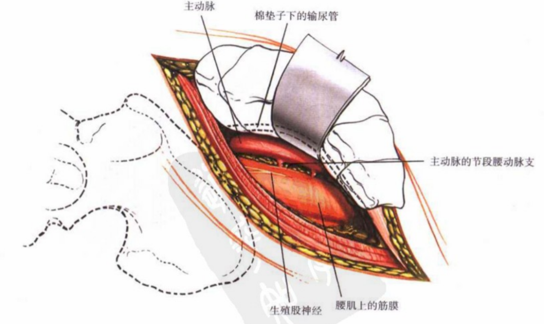 椎板外切迹入路图片