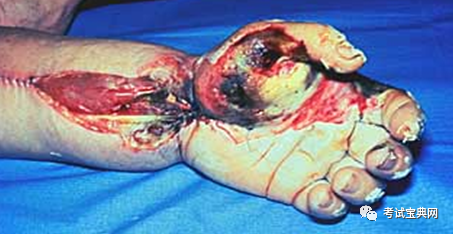 电烧伤和化学烧伤