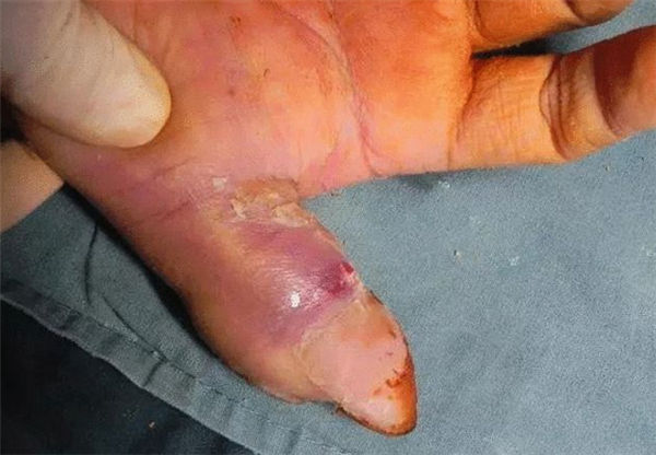 男子吵架被同事咬后竟要截肢 医生:有时人咬伤会比动物更严重