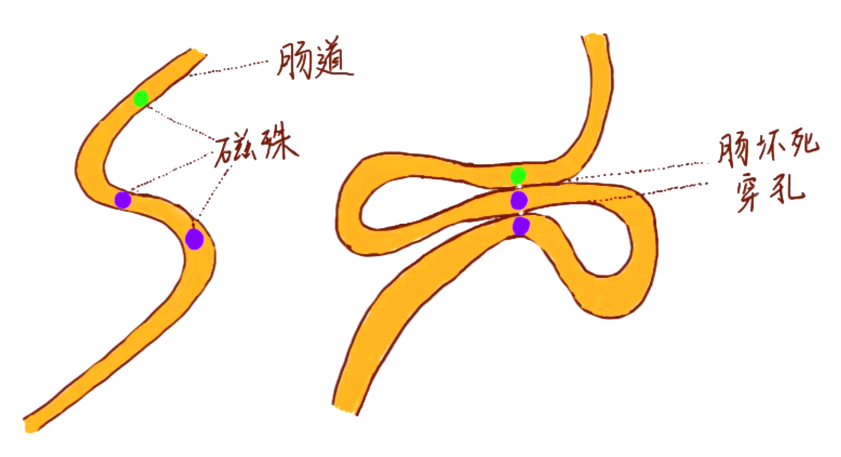 磁力珠吞一颗最简单方法=磁力珠吞到肚子里有什么危害