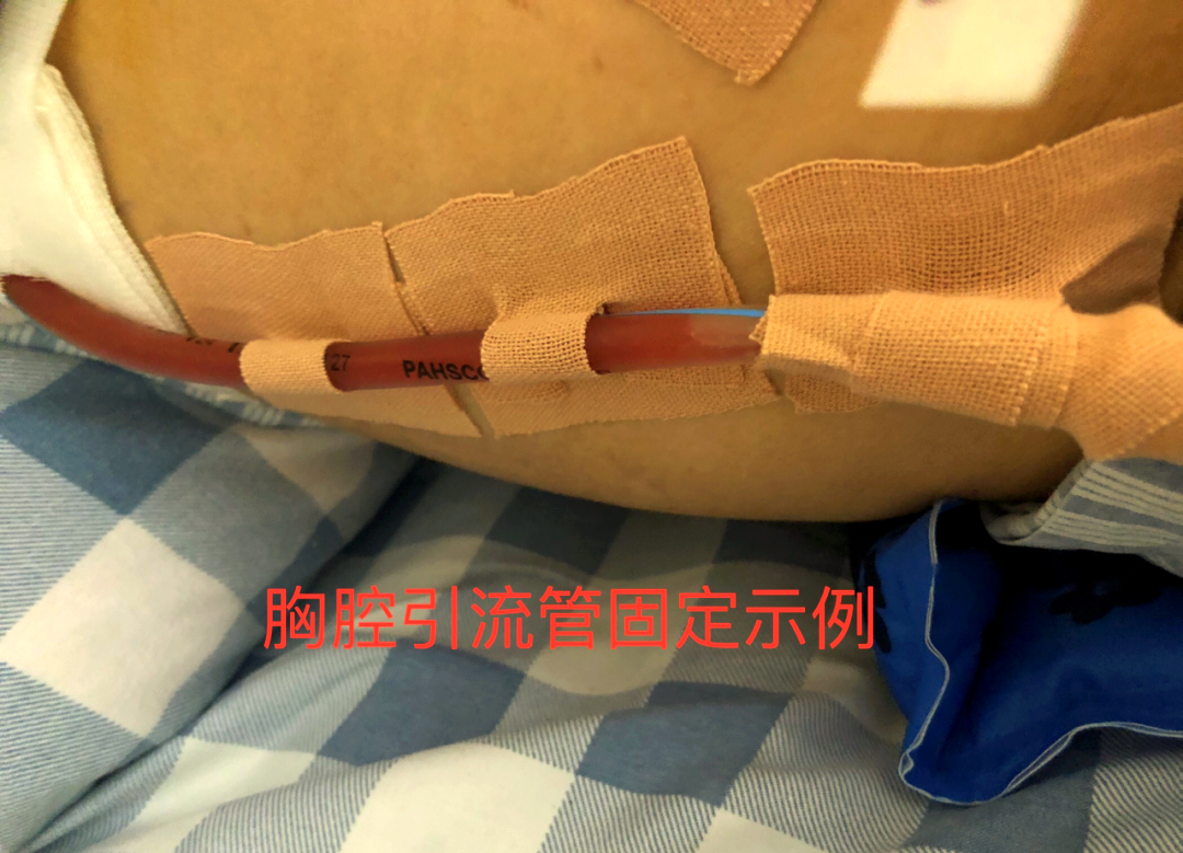 胸外科术后常见的引流管种类及护理方法