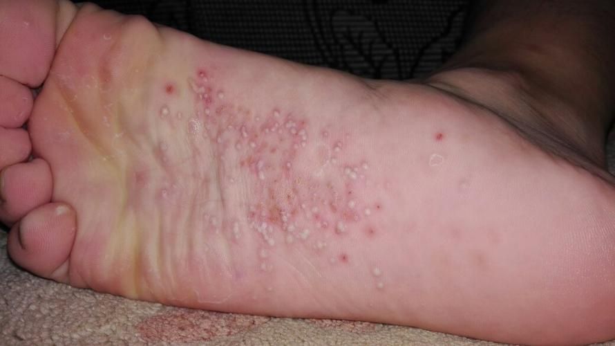 脚气:脚气是由真菌感染引起的一种皮肤病,主要表现为脚部皮肤发痒,脱