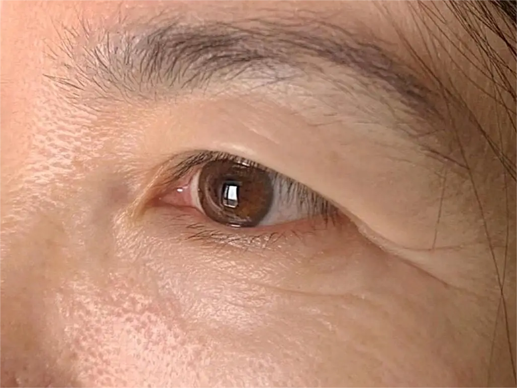 40 眼睛衰老得像50怎么办?医生告诉你:眼部衰老这么救!