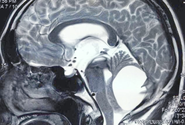 大枕大池及其鉴别诊断详解