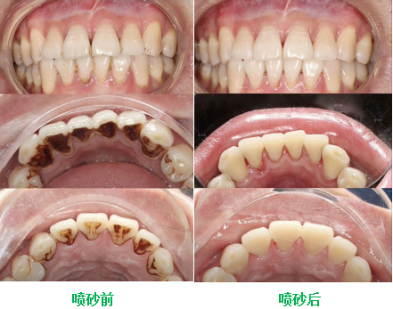 深入了解喷砂洁牙:作用及注意事项详解