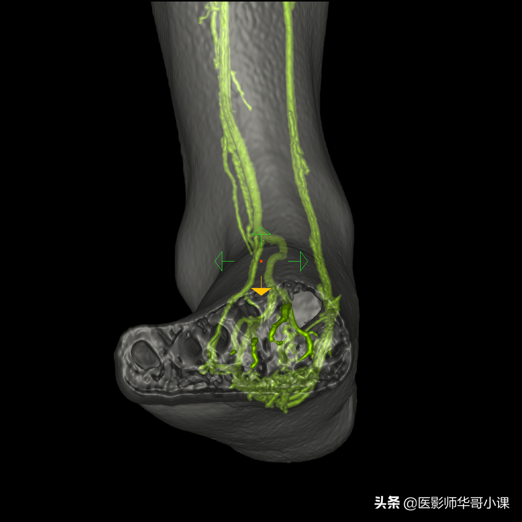 足部血管解剖,非增强足血管磁共振扫描