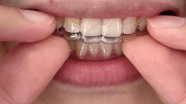 做牙齿矫正一定要记住这3点,有效整牙不被套路