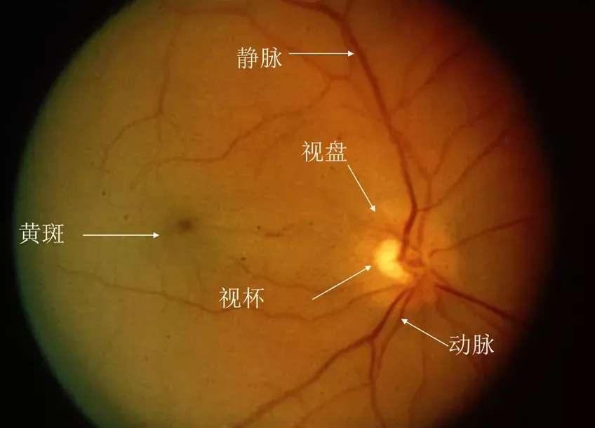 身边血压高的朋友,高血压会引起眼底病变