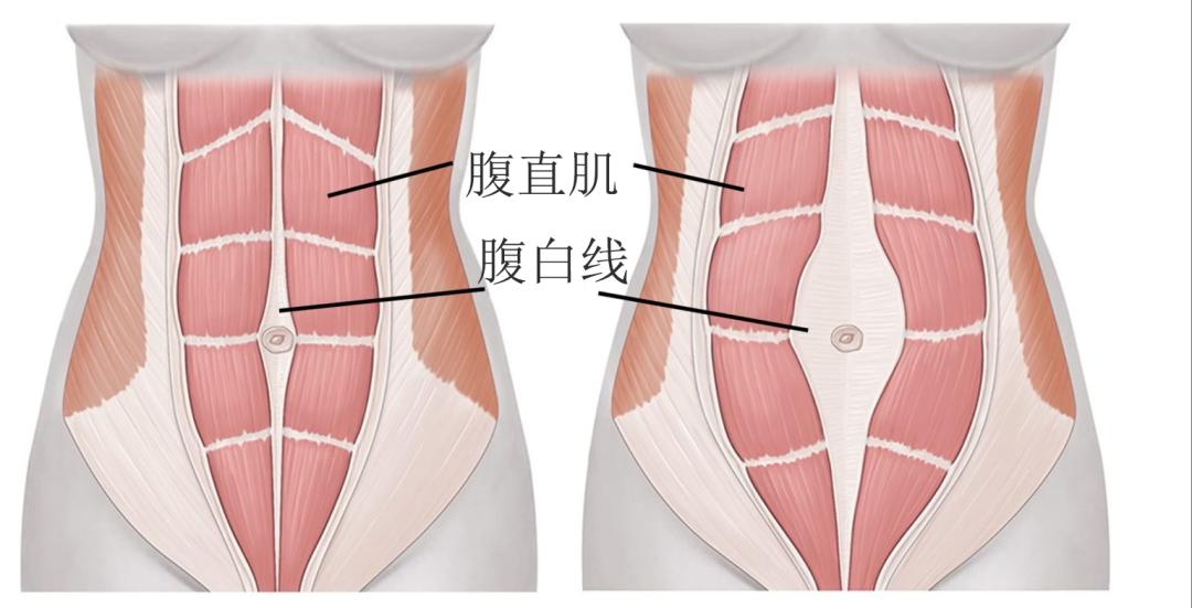 女孩子腹白线图片图片