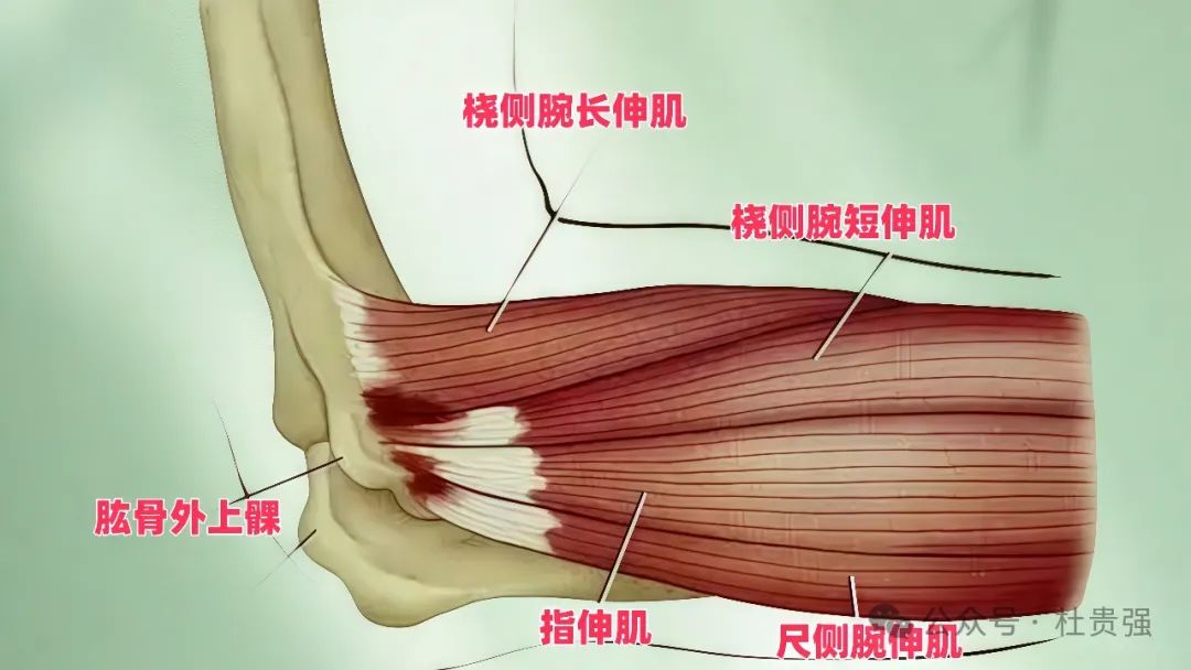 网球肘就是肱骨外上髁炎