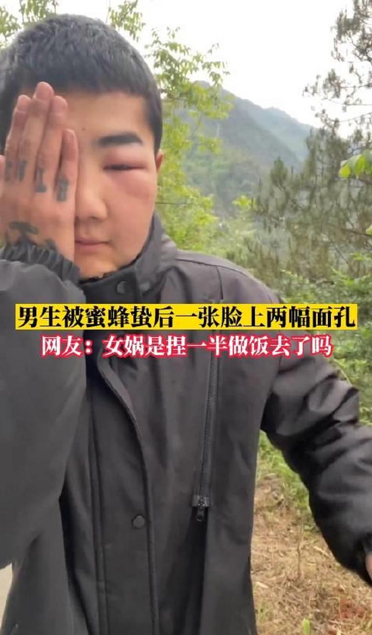 一男生不小心被蜜蜂蛰到脸,结果半边脸正常半边脸高高肿起简直判若