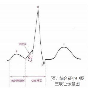 心室预激波心电图特点图片