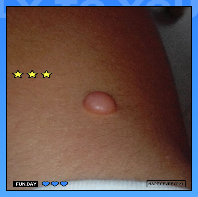 「宝鸡皮肤病医院解答」肉瘊子的成因,治疗与预防方法