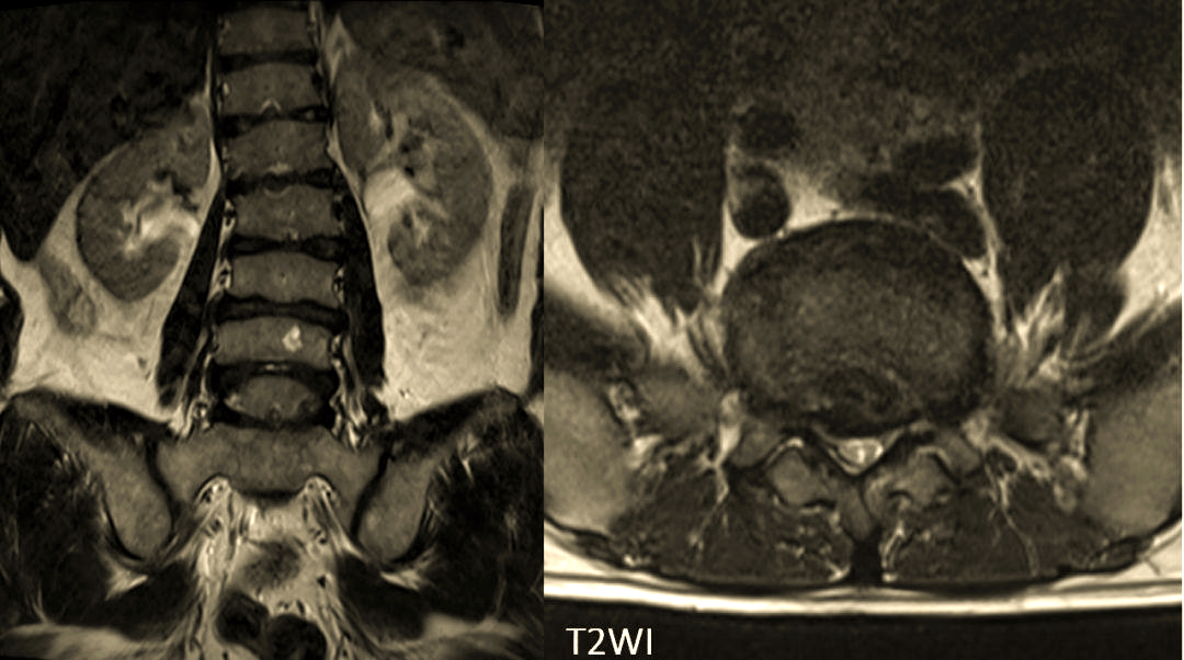 青少年驼背的病因与影像研究:休门氏病的深度解析