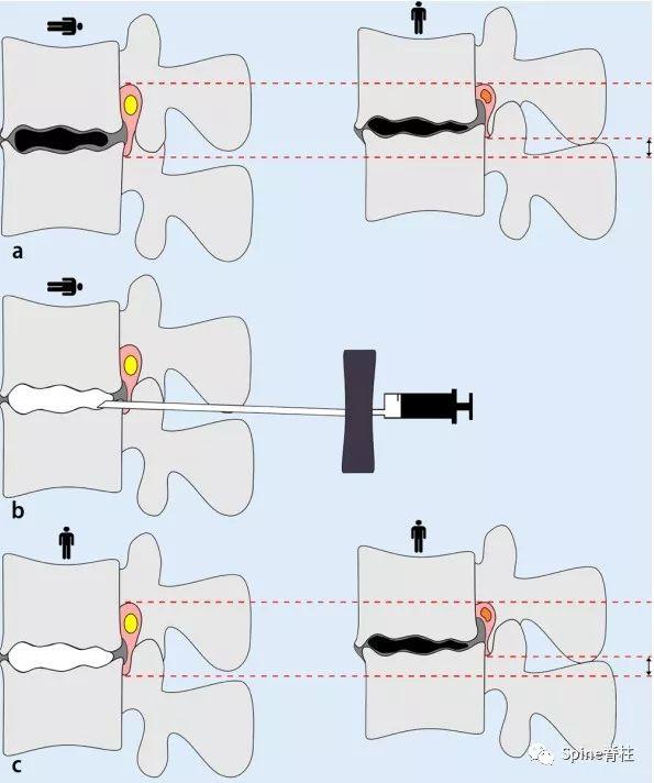 骨水泥椎体成形术图片图片