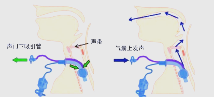 声门下正压技术:气管切开患者康复的希望