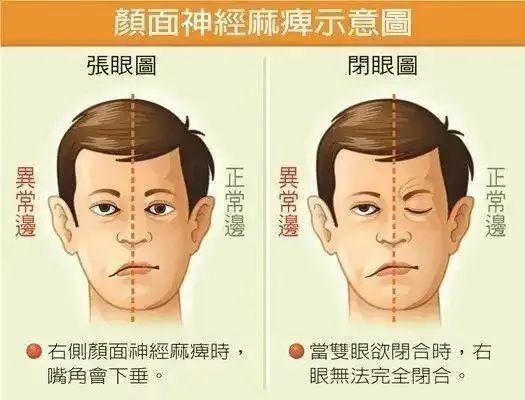 近日,34岁的的王女士一觉醒来,却发现自己口歪眼斜,一侧面部肌肉瘫痪