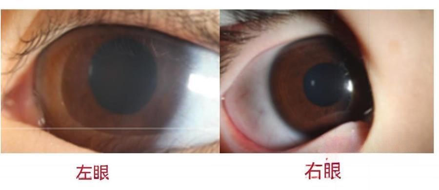 5岁女童黑眼珠大小不一,竟是先天性青光眼"作祟"