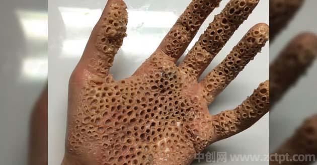 玉米男孩是真实事件吗,玉米男孩图片原图恐怖吗(十宗罪几) Holes in the body/BY