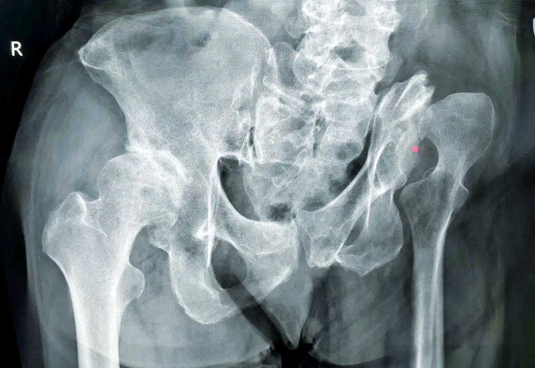 先天性髋关节脱位的预防,诊断与治疗策略