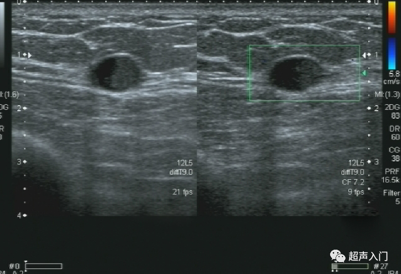 「病例分享」乳腺导管原位癌超声诊断一例