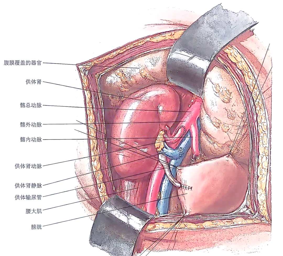 肾脏移植手术全解析:过程,位置选择与注意事项