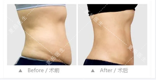 腹壁成形术后几天可以消肿
