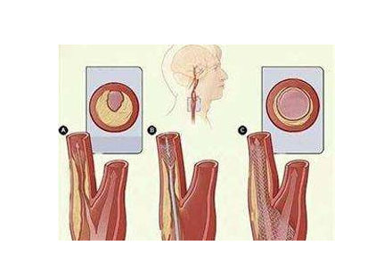 血管外科刁永鹏:颈动脉狭窄你真的了解么?4个方面带你认识