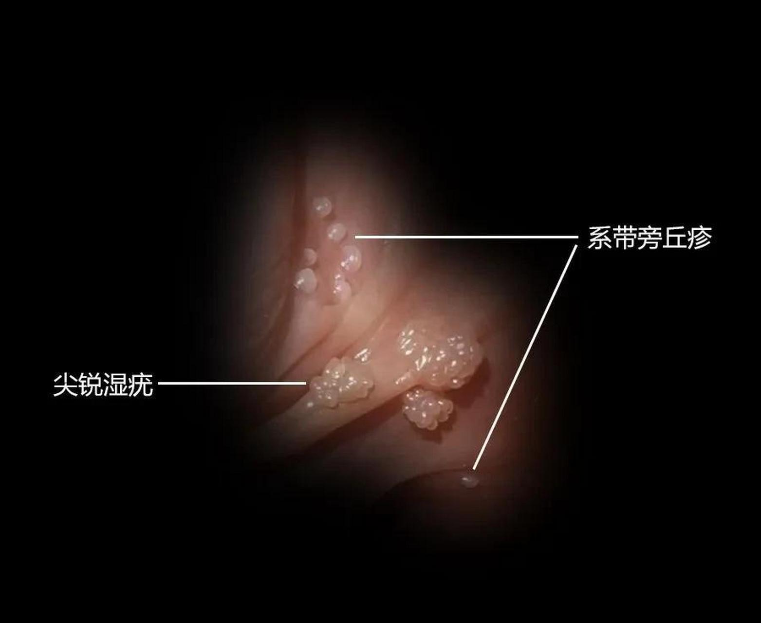 男性朋友都来看看,这是系带部位容易出现的情况:#尖锐湿疣# 与系带旁