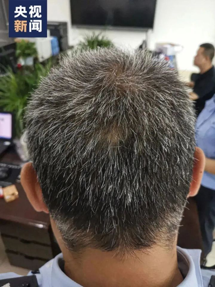 《狂飙》中的安欣为何会"一夜白头"?皮肤科医生详解版来了