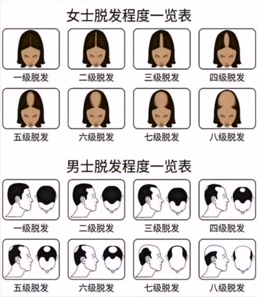 女性会患雄激素性脱发吗?