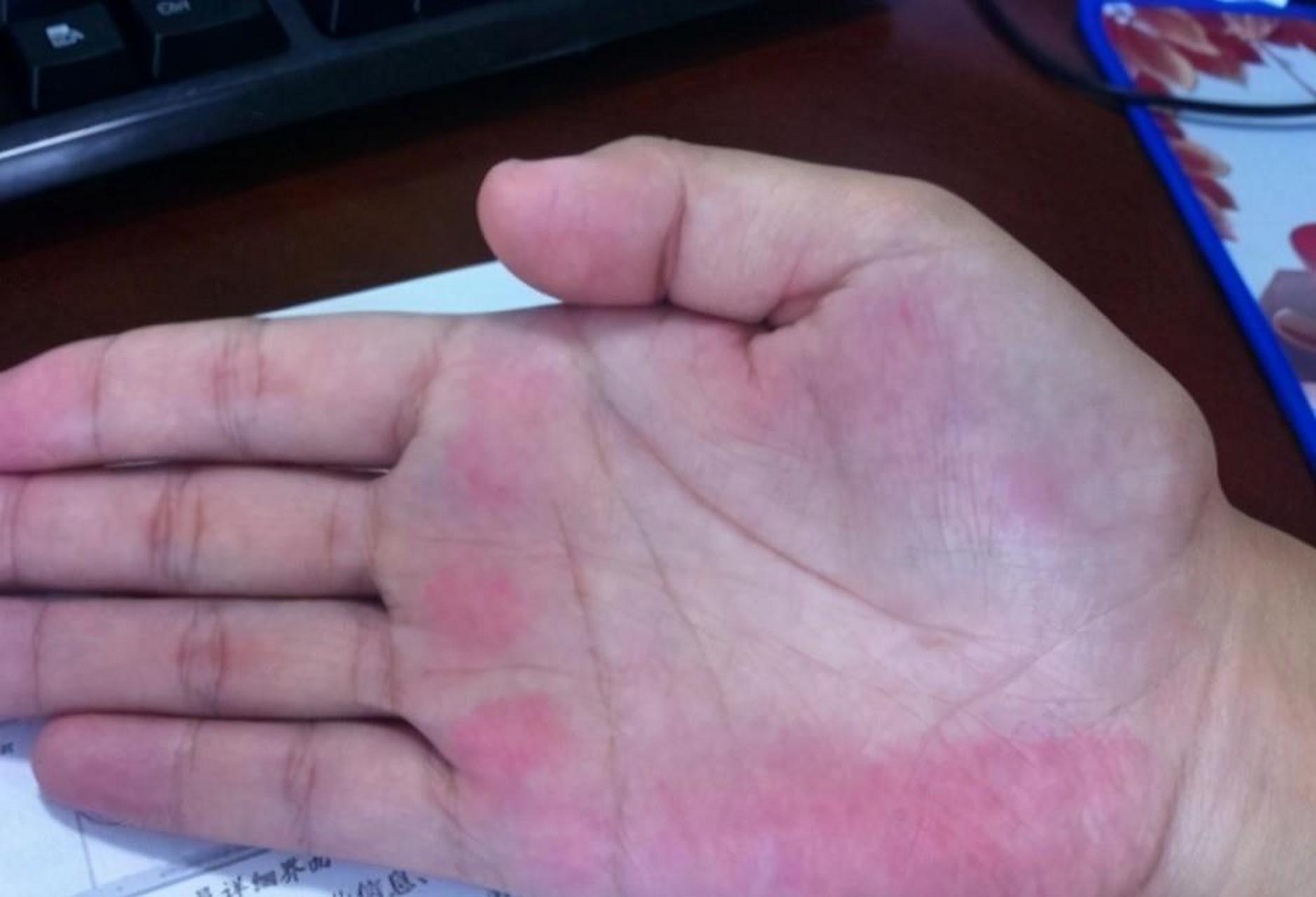 45岁的杨先生,手掌莫名的发红,发热,而且分布在手掌两侧,以为是皮肤