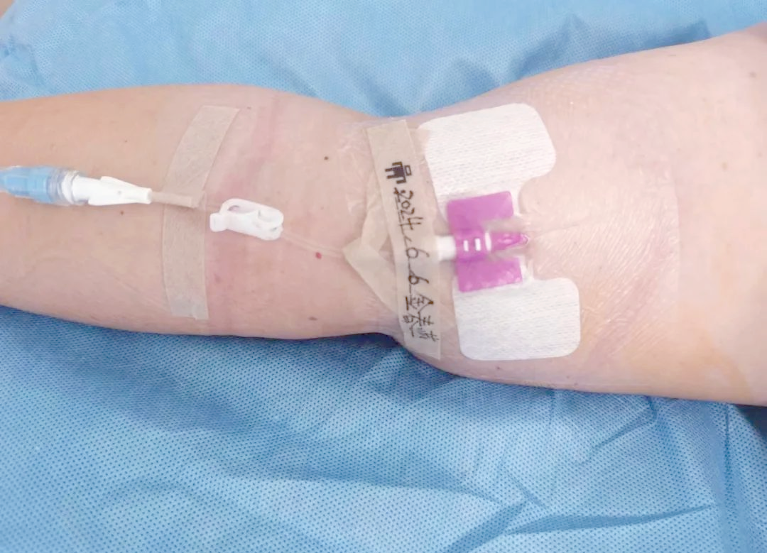 迷你中长导管:创新静脉输液技术带来更佳护理体验