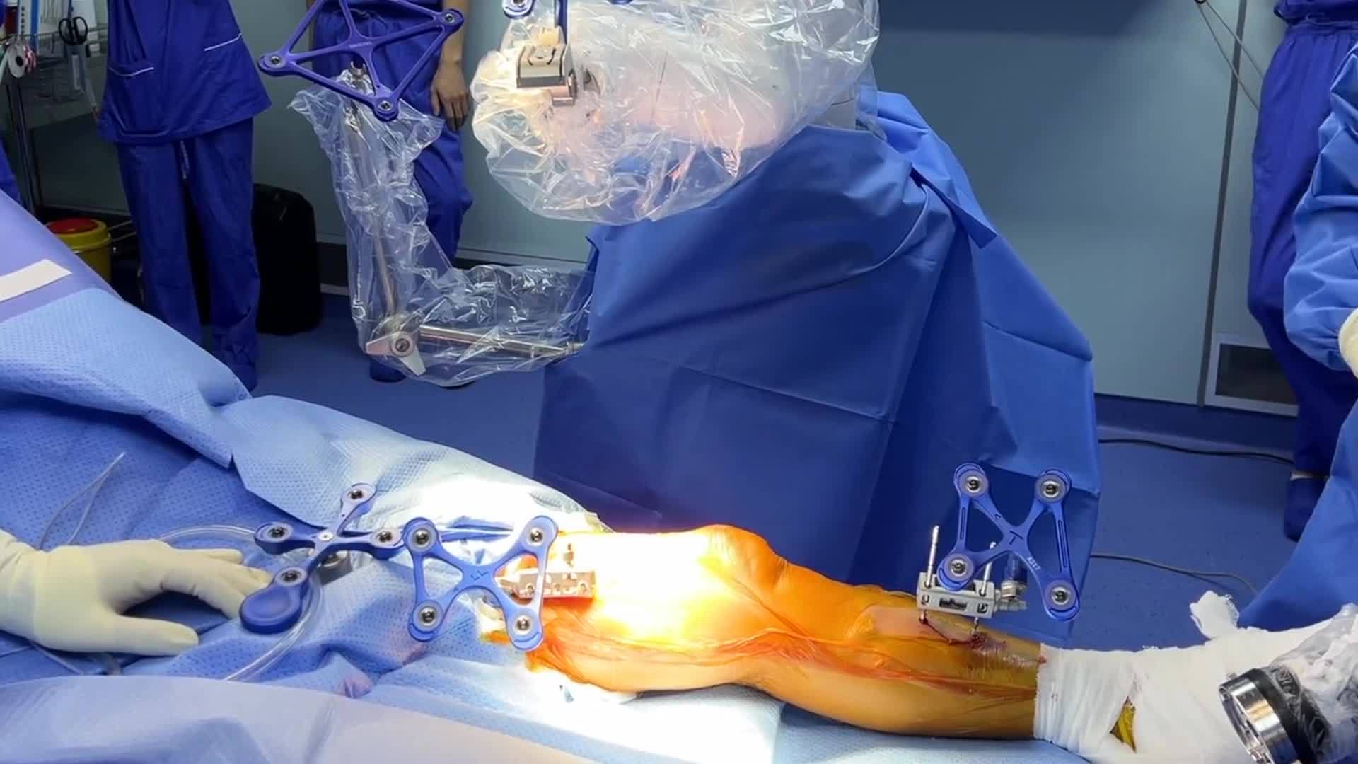 深河人民医院开展河源首例机器人辅助下人工全膝关节置换术