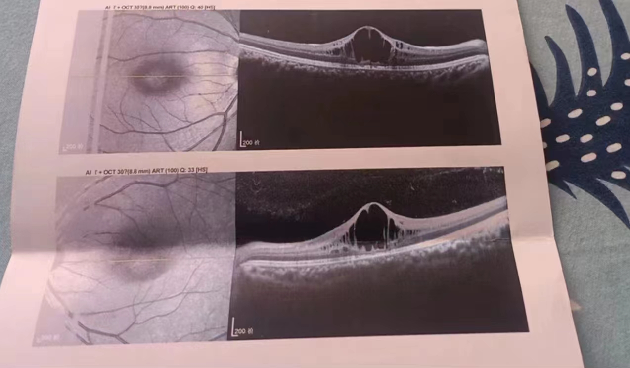 黃斑水腫一個月,水腫開始慢慢吸收