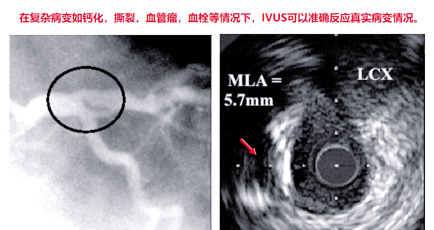 血管内超声(IVUS)技术全面解析,一次了解清楚!