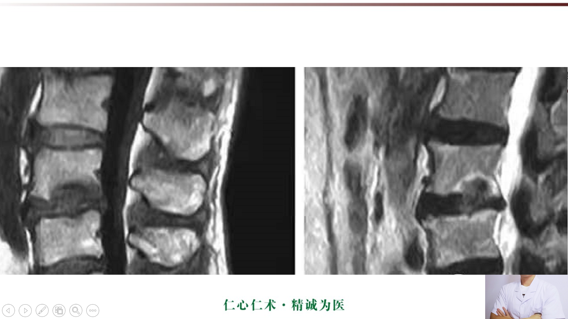 許莫氏結節及終板炎影像診斷