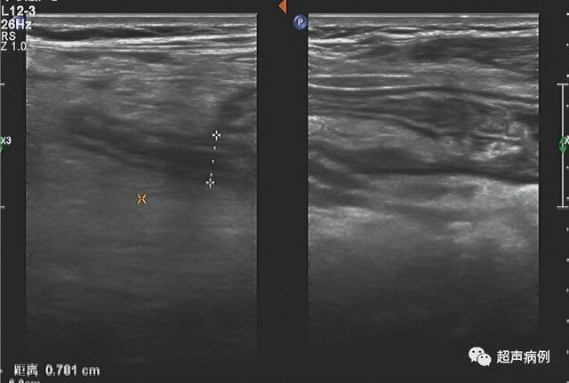 阑尾炎超声图图片