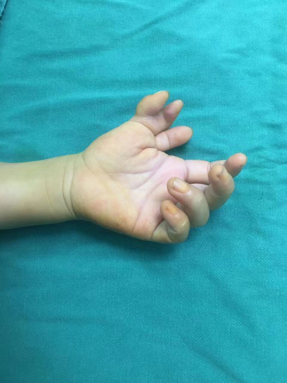 三岁的手指畸形宝宝