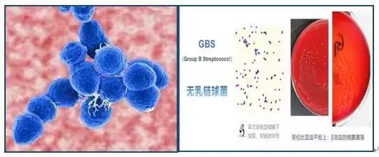 「优生优育」b族链球菌筛查阳性怎么办?