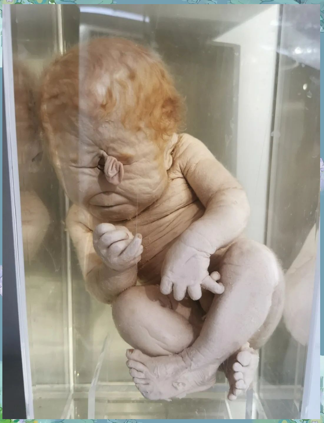 独眼畸形胎儿:形成原因及预防策略详解