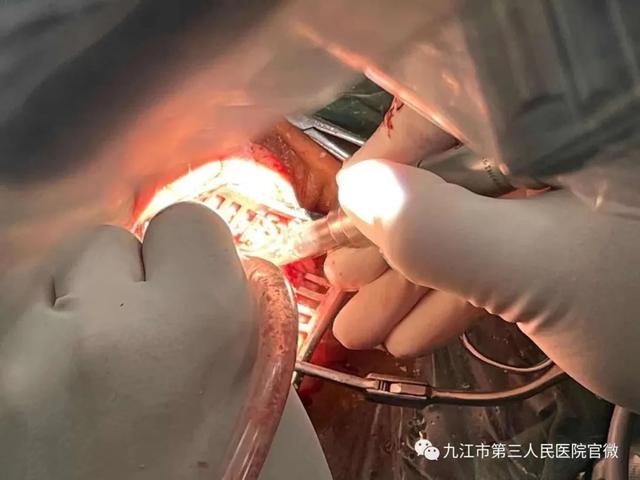 甘于不避为仁—九江市第三人民医院成功完成显微镜下乳突根治 鼓室