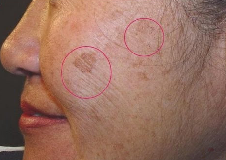 「硒与健康」老人斑突然增多,当心加速衰老