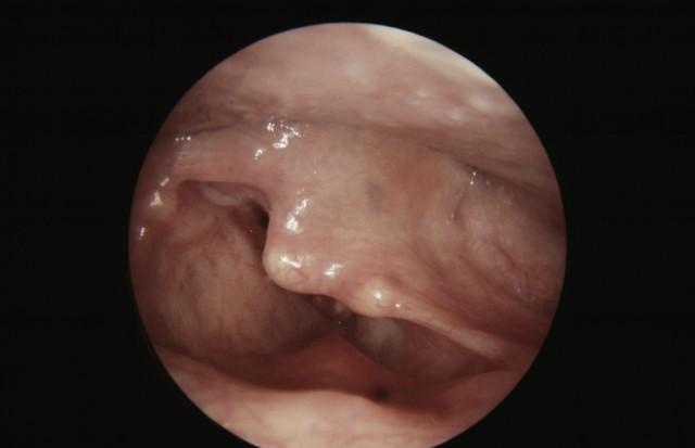 喉癌能根据声音嘶哑直接诊断吗?其早期有哪些症状?