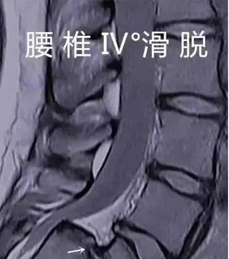 腰椎滑脱分级图片