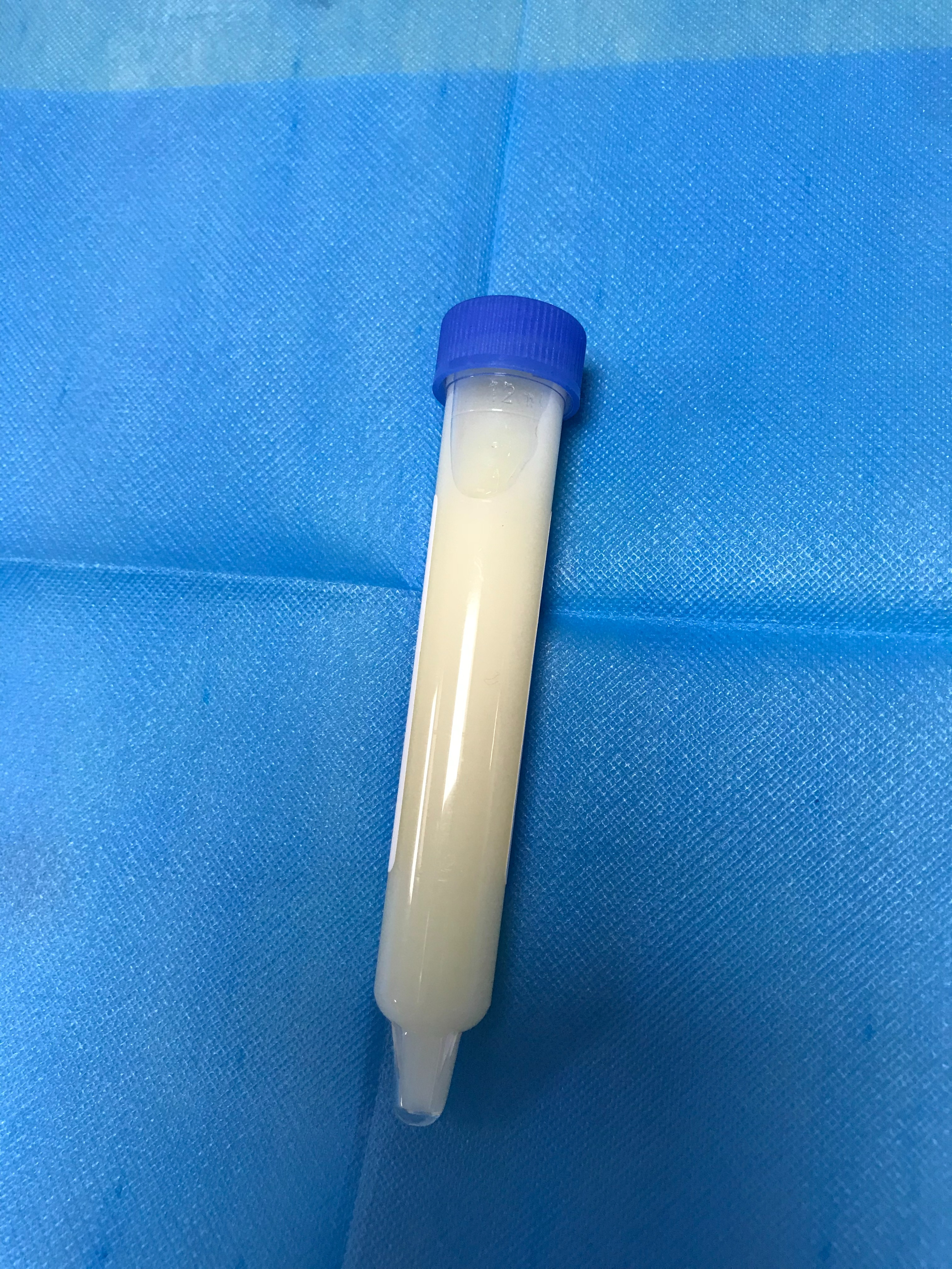 湖南六旬男子解出"牛奶"尿,竟是这个原因